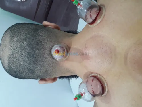 حجامة-hijama وقائية وعلاجية