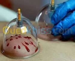 hijama sona