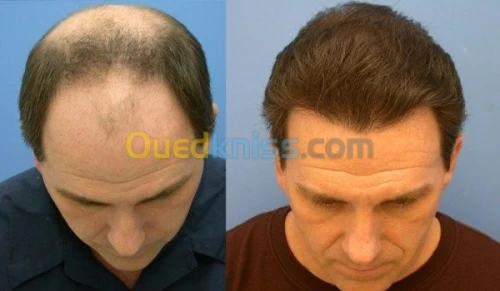 Greffe de cheveux زراعة الشعر بتركيا 
