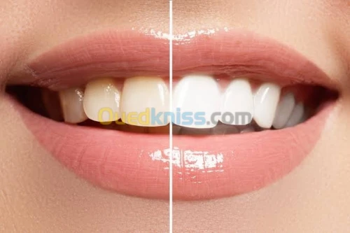 Blanchiment dentaire en promotion 