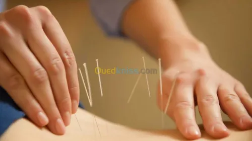 ACUPUNCTURE-HIJAMA