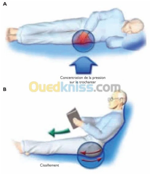 Matelas anti escarres de classe 1 type