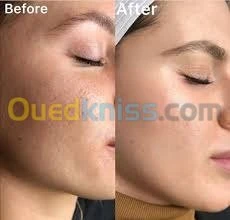 Microneedling et BBglow 