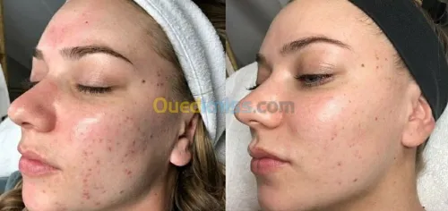 Microneedling et BBglow 