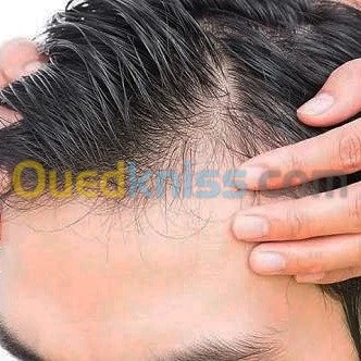 Greffe capillaire fiv chirurgie 