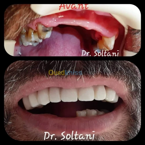 Implantant, soins dentaires esthétique