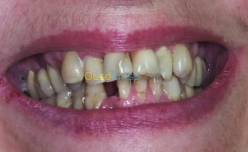 Implantant, soins dentaires esthétique