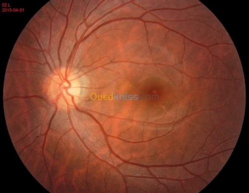 Retinographe non mydriatique Angio