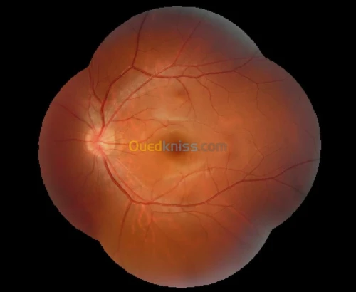 Retinographe non mydriatique Angio