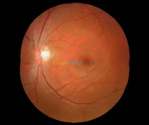 Retinographe non mydriatique Angio