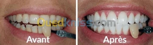 Blanchiment 08h30 à 00h00