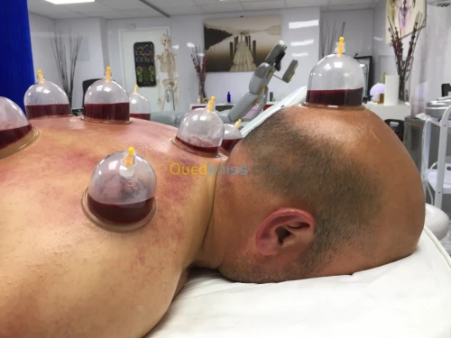 Hijama