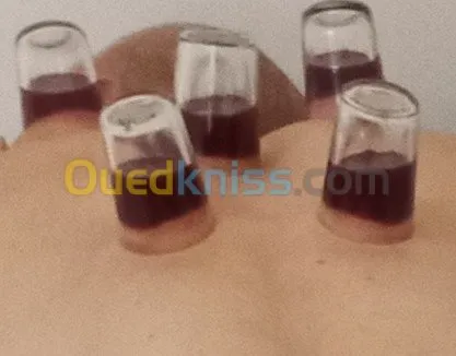 الحجامة الوقائية والعلاجية السبالة