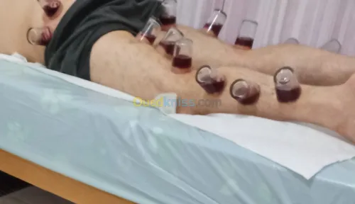 الحجامة الوقائية والعلاجية السبالة