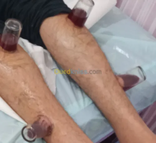 الحجامة الوقائية والعلاجية السبالة