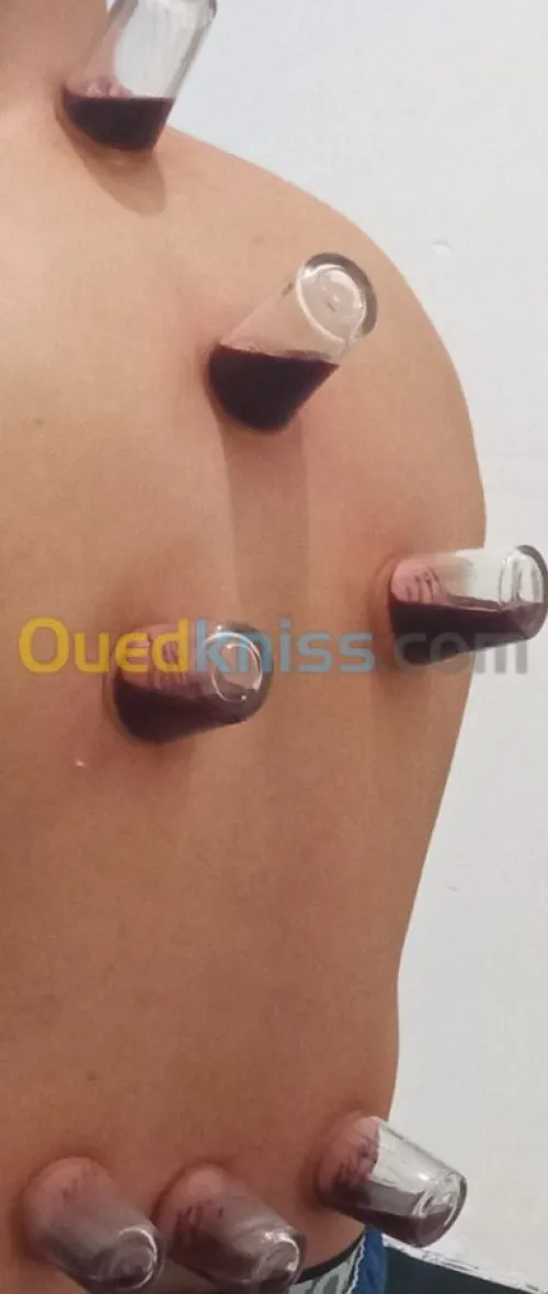 الحجامة الوقائية والعلاجية السبالة