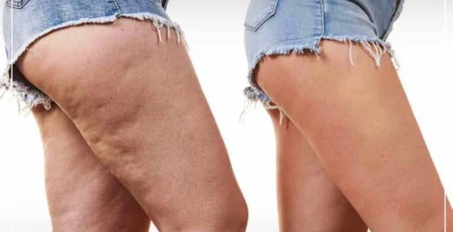 Crème anti cellulite soin du corps