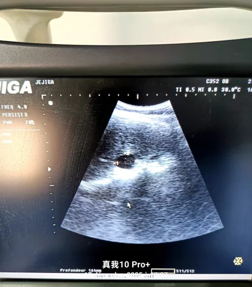 Echographie