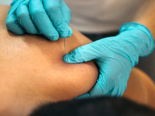 العلاج بالحجامة والطب الصيني