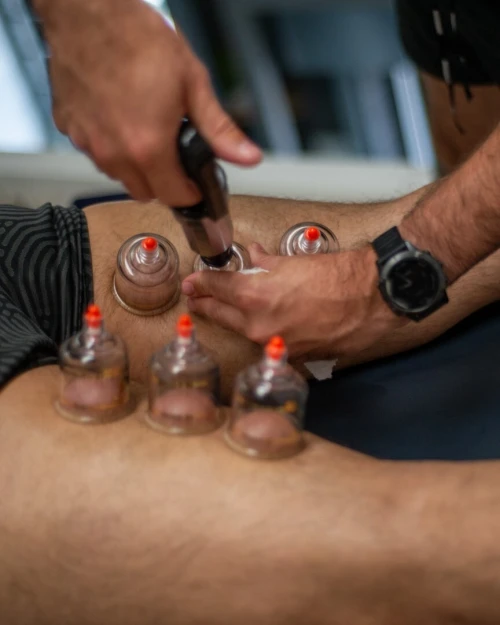 العلاج بالحجامة والطب الصيني