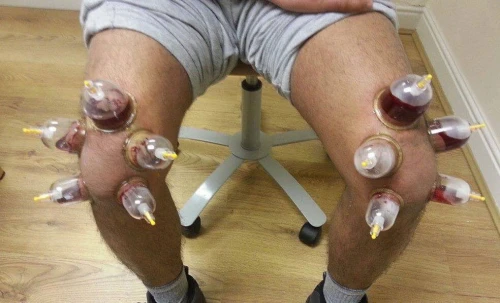العلاج بالحجامة والطب الصيني