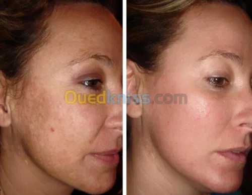 Esthétique faciale pour femmes 