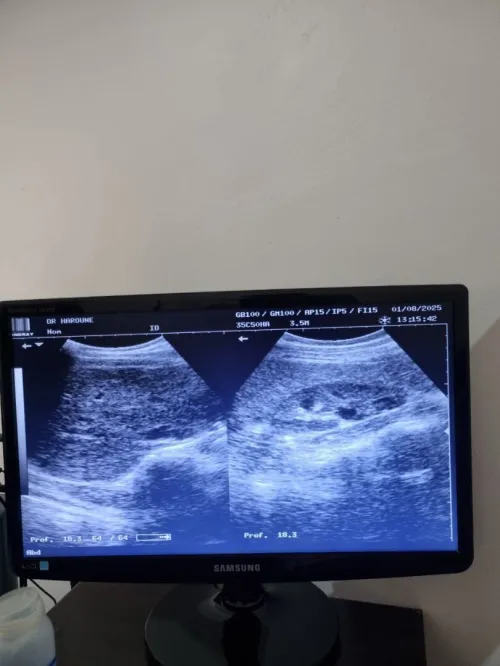 Echographie Mindray 9900