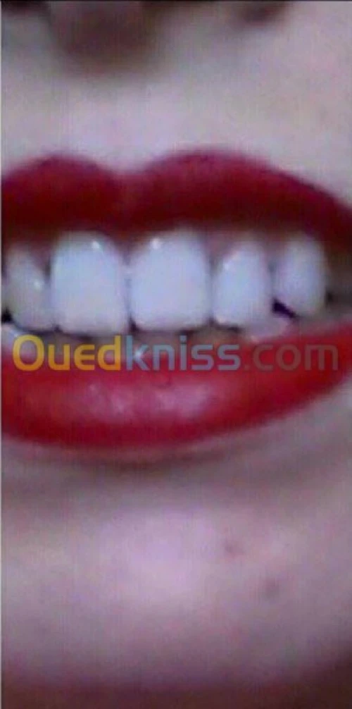 Blanchiment dentaire 