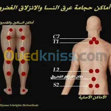 Hijama médicale