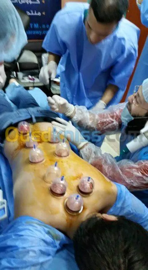 Hijama médicale