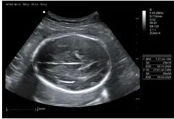 Echographe portable Doppler neuf