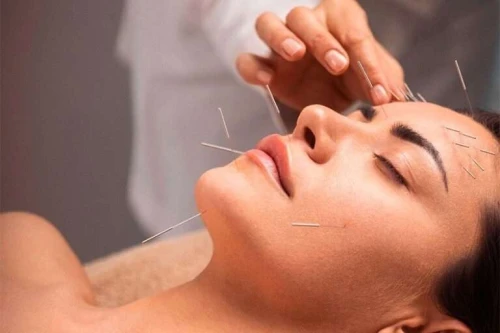 Acupuncture الطب الصيني و العلاج بالابر الصينية 