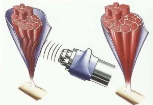 Matériel de rééducation physiothérapie