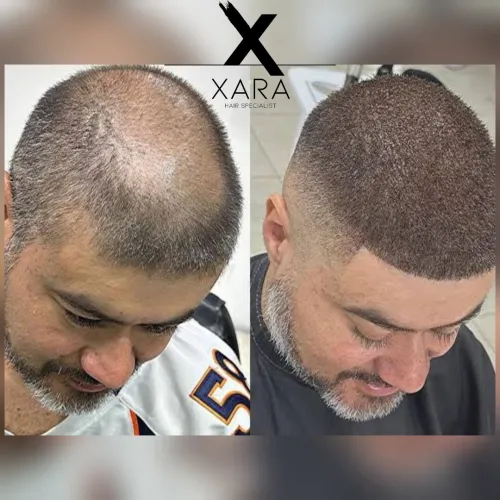 Fixateur de Fibres Capillaires- XARA