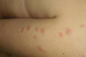 anti punaise de lit 