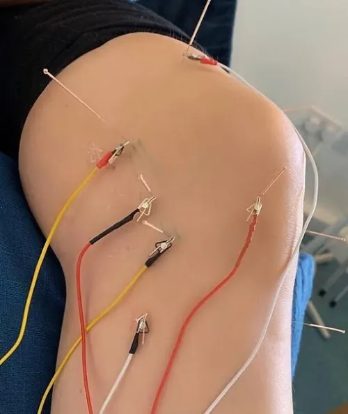 محفز كهربائي للإبر الصينية  Eléctrostimulateur d'acupuncture (Stimulateur)