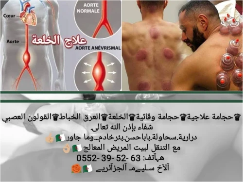حجامة 