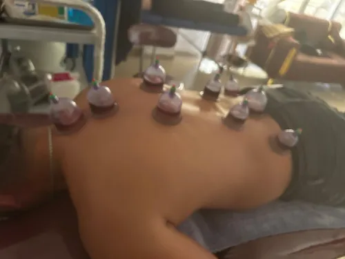 حجامة دموية و جافة ، مساج hijama, massage