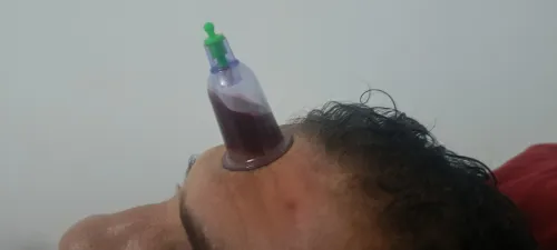 حجامة دموية و جافة ، مساج hijama, massage