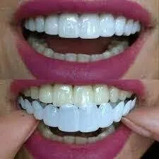 snap on smile
