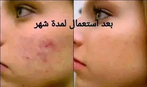 ماسك لتبييض