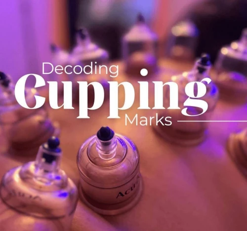 Cupping therapy ( hijama) acupuncture Chinoise flashing serviette de feu