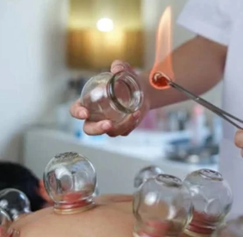 Cupping therapy ( hijama) acupuncture Chinoise flashing serviette de feu