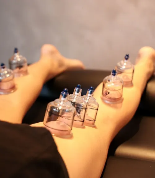 Cupping therapy ( hijama) acupuncture Chinoise flashing serviette de feu