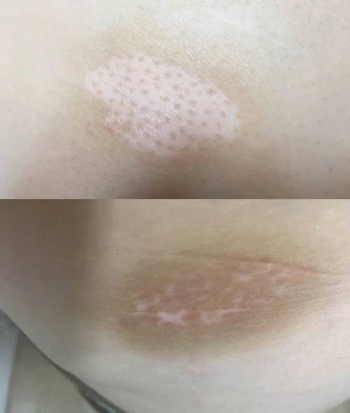 Excimer laser 308nm vitiligo