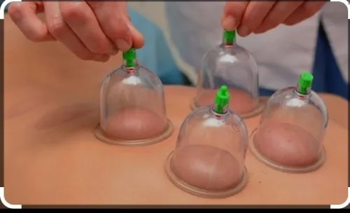 Hidjama médicale 
