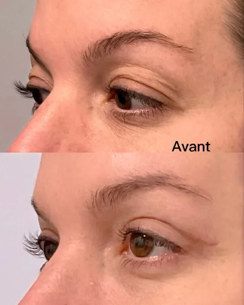 Blépharoplastie 